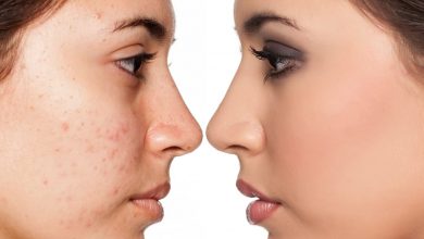 علاج حب الشباب